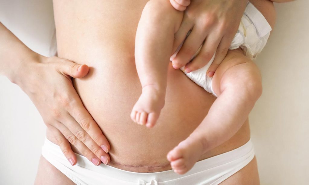 post parto cicatrice parto cesareo mamma con neonato
